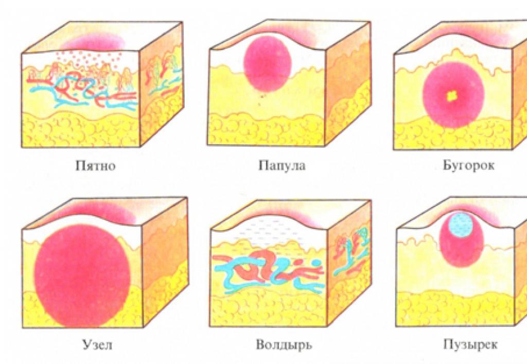 Сыпь - симптомы - кожные болезни Инфекционные заболевания протекающие с сыпью